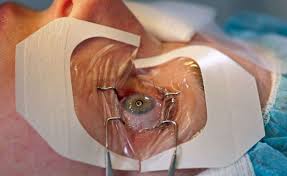 LASIK